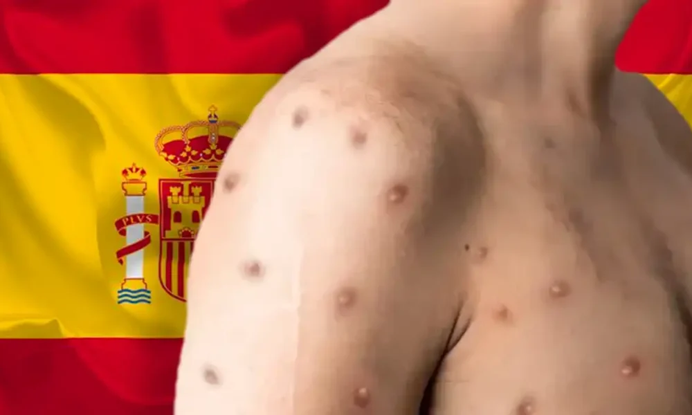 España es el país europeo con más casos de Viruela del Mono
