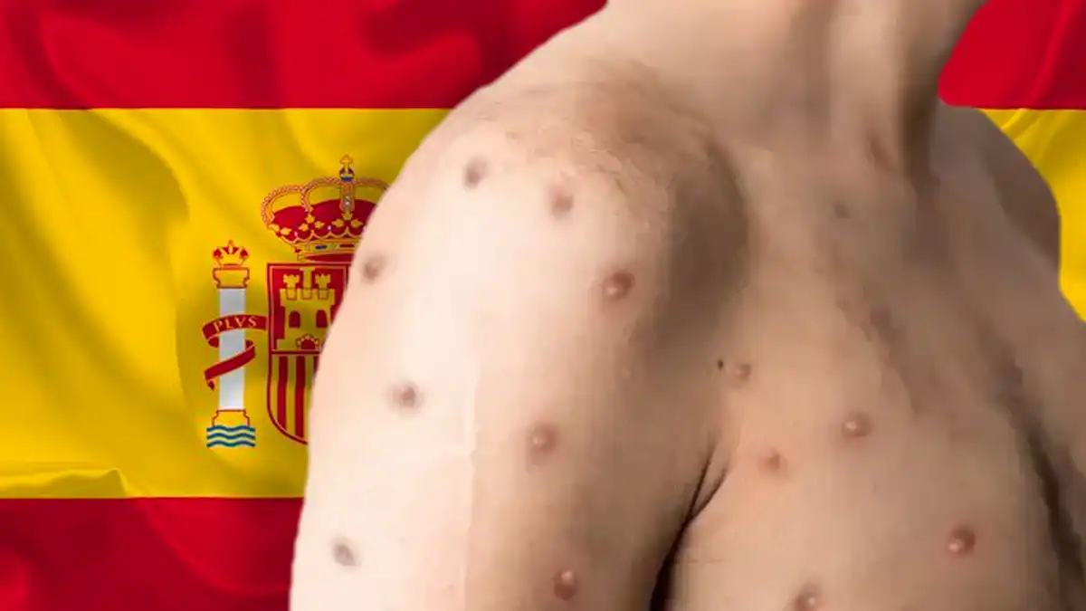 España es el país europeo con más casos de Viruela del Mono